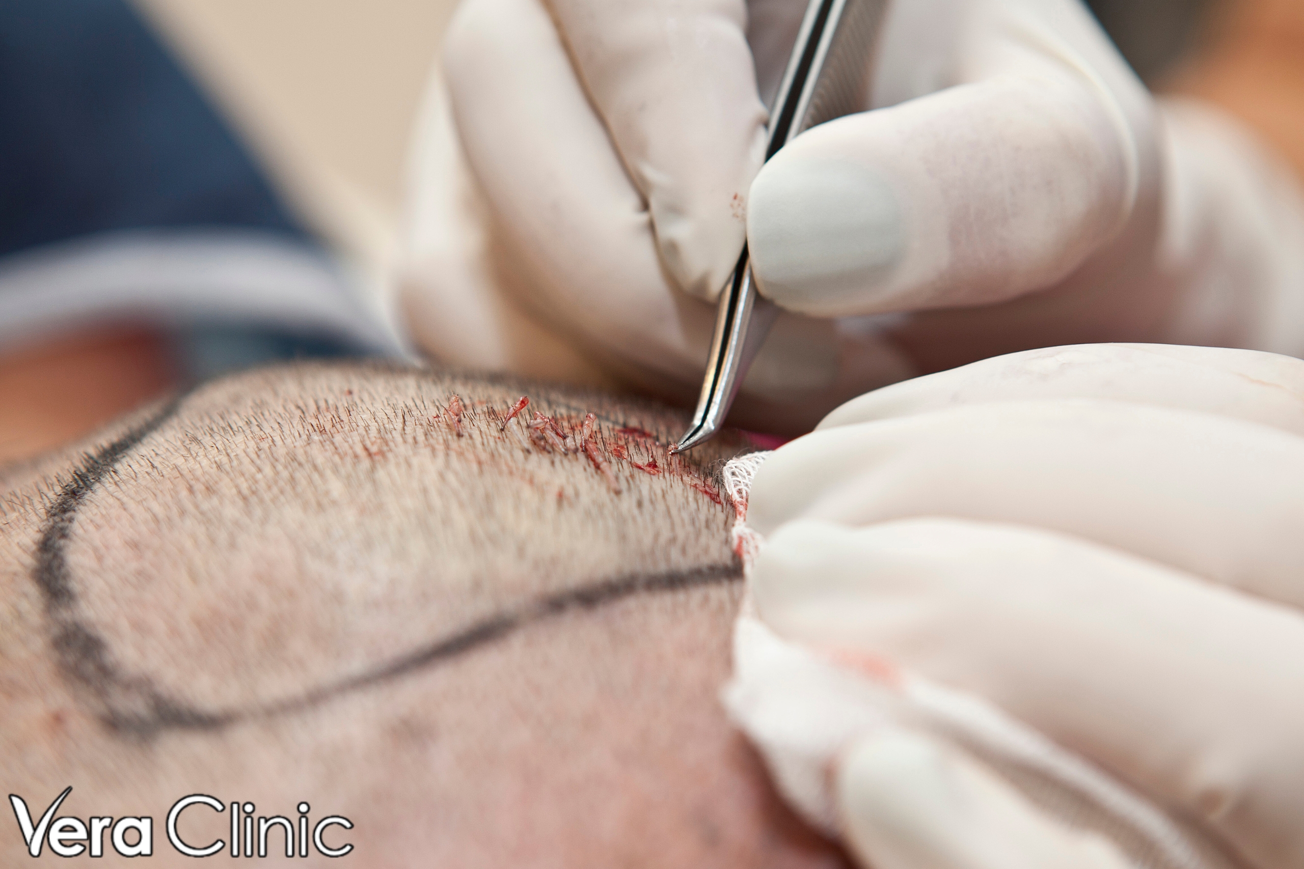 hair implants turkey