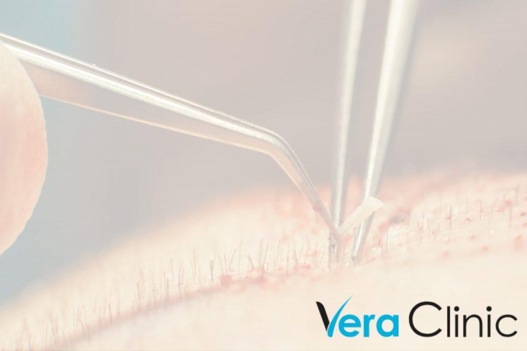 Traveling To Turkey For Hair Implants: Key Considerations For A Successful Trip